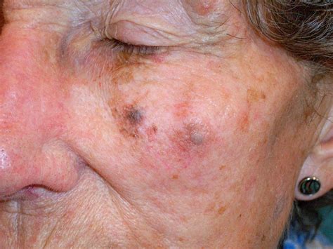 pics of melanoma on face
